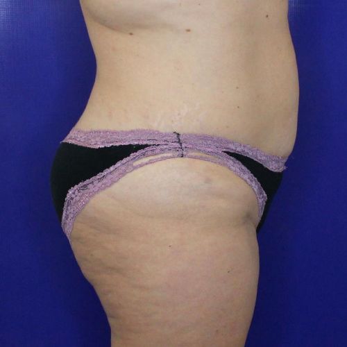 before halo lift female patient side view case 2545