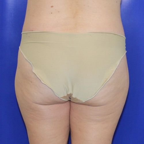 after halo lift female patient back view case 2545