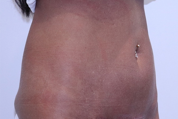 After Mini Tummy Tuck Female Patient Diagonal Angle View Case 2270