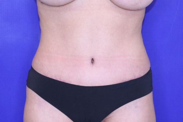 after tummy tuck female patient front view case 2443