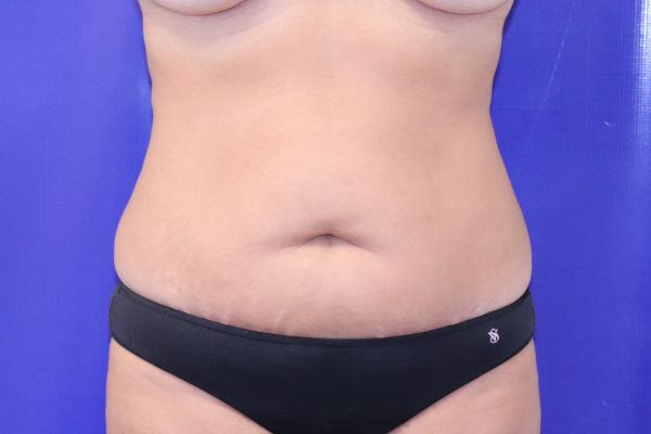before tummy tuck female patient front view case 2443