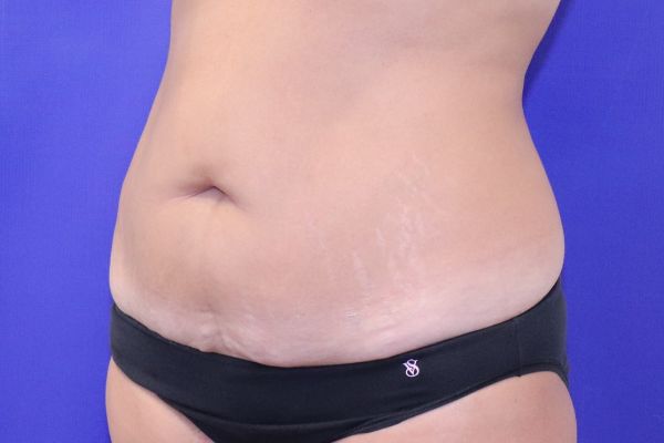 before tummy tuck female patient front angle view case 2443
