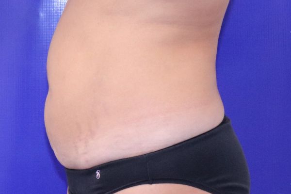 before tummy tuck female patient side view case 2443