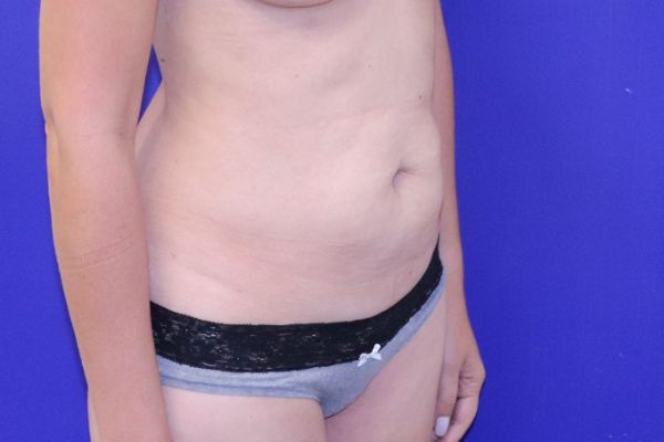 before tummy tuck female patient front angle view case 2450