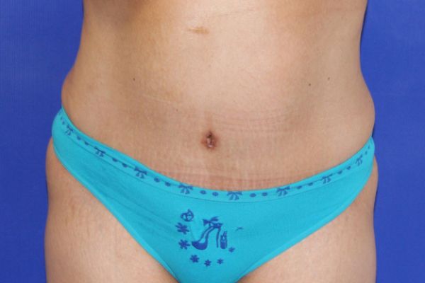 after tummy tuck female patient front view case 2457