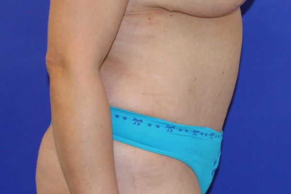 after tummy tuck female patient side view case 2457