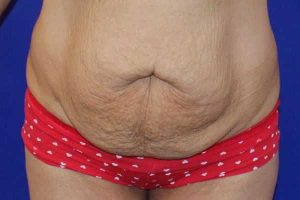 before tummy tuck female patient front view case 2457