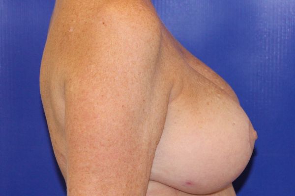 After Breast Revision Female Patient Side Angle View Case 2847