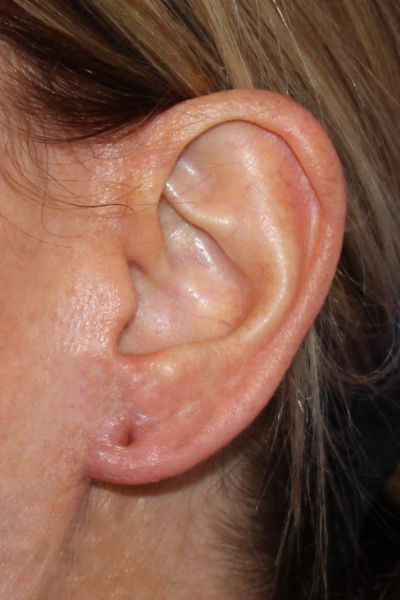 After Earlobe Reduction Case 2854