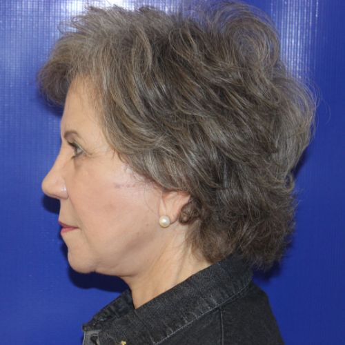 After Face and Neck Lift Female Patient Side Angle View Case 2874