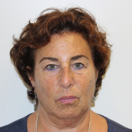 After Face and Neck Lift Female Patient Front Angle View Case 2883