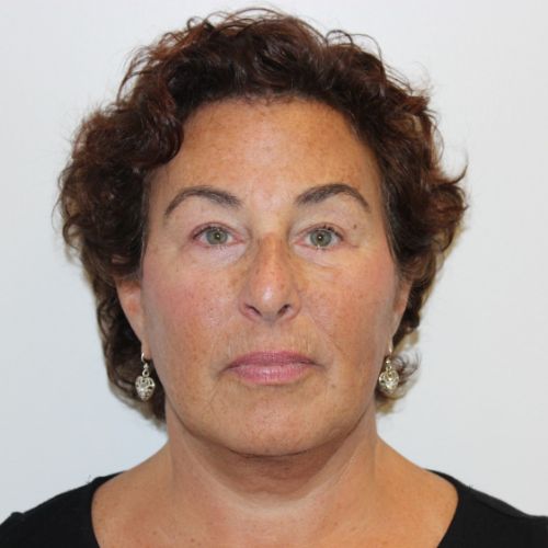 After Face and Neck Lift Female Patient Front Angle View Case 2883