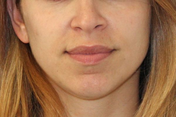 Before Filler Female Patient Front Angle View Case 2857