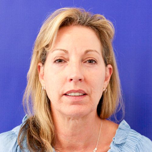 Before Filler Female Patient Front Angle View Case 2860