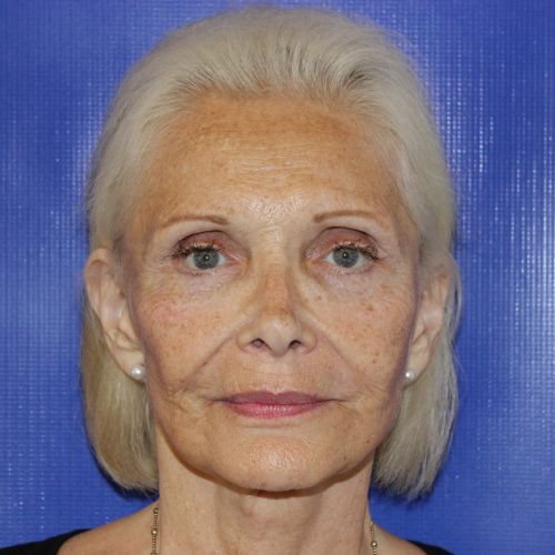 Before Filler Female Patient Front Angle View Case 2865