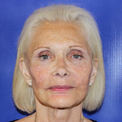 After Filler Female Patient Front Angle View Case 2865