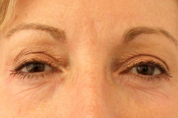 Before Filler Female Patient Front Angle View Case 2868