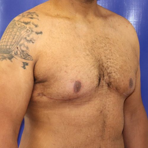 After Gynecomastia Male Patient Diagonal Angle View Case 2886