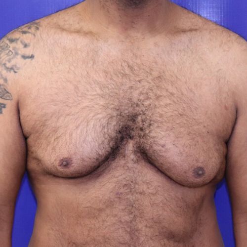 Before Gynecomastia Male Patient Front Angle View Case 2886