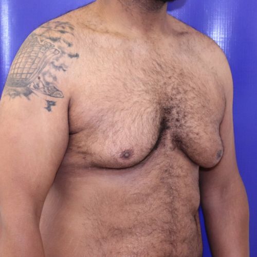 Before Gynecomastia Male Patient Diagonal Angle View Case 2886