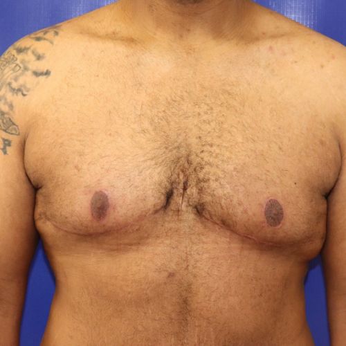 After Gynecomastia Male Patient Front Angle View Case 2886