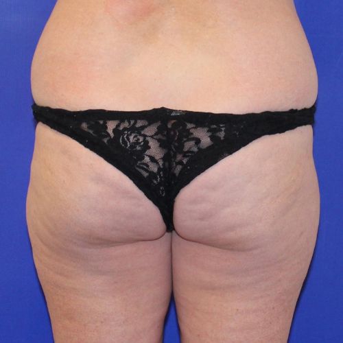 Before Halo Lift Female Patient Back Angle View Case 2893