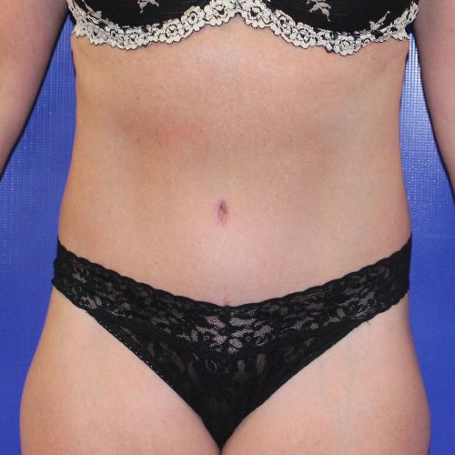 After Halo Lift Female Patient Front Angle View Case 2893
