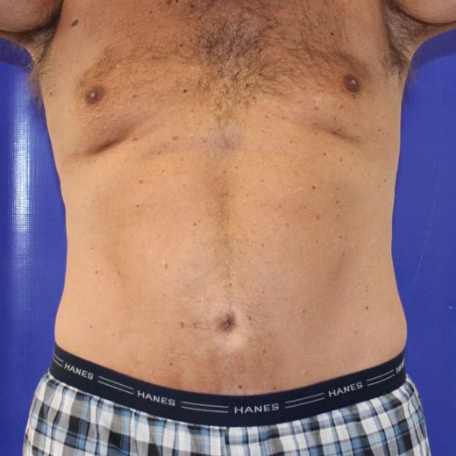 After Halo Lift Male Patient Front Angle View Case 2902