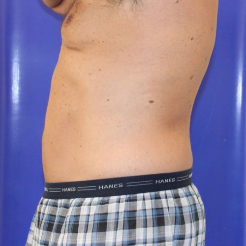After Halo Lift Male Patient Side Angle View Case 2902