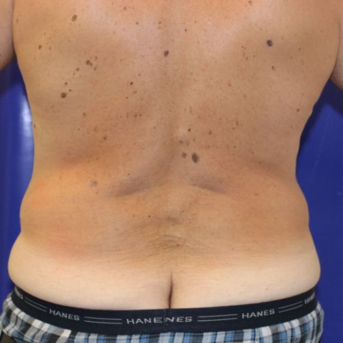 Before Halo Lift Male Patient Back Angle View Case 2902