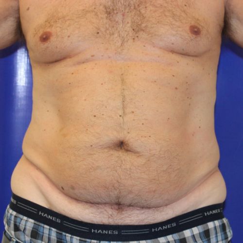 Before Halo Lift Male Patient Front Angle View Case 2902