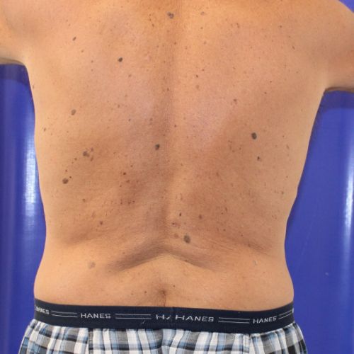 After Halo Lift Male Patient Back Angle View Case 2902