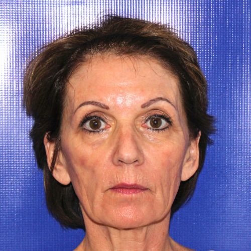 Before Sculptra Female Patient Front Angle View Case 2909