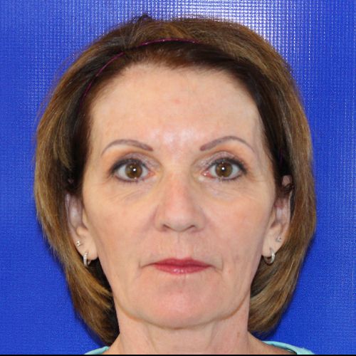 After Sculptra Female Patient Front Angle View Case 2909