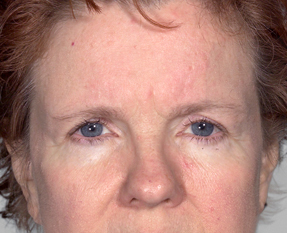 before blepharoplasty female patient front view case 3333