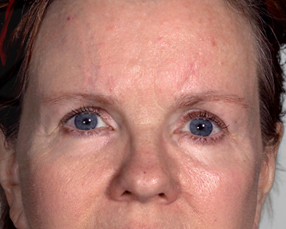 after blepharoplasty female patient front view case 3333
