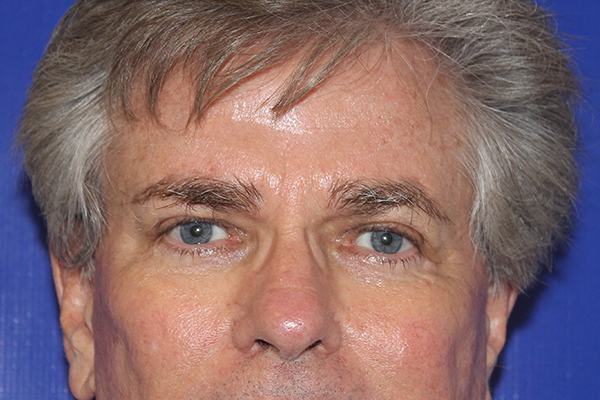 after blepharoplasty male patient front view case 3346