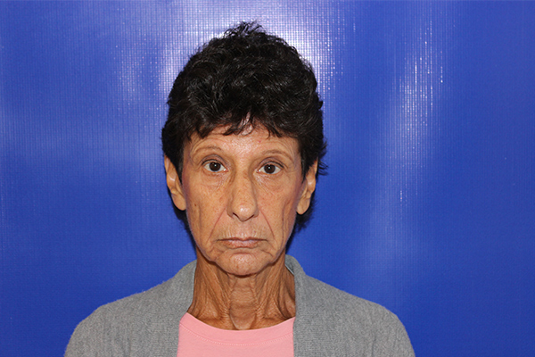 before browlift female patient case 3336