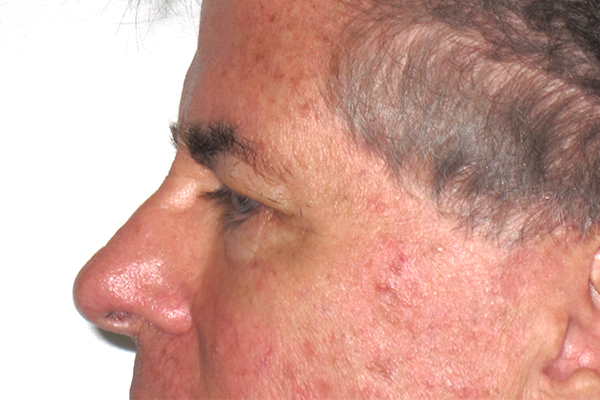 before blepharoplasty male patient side view case 3341