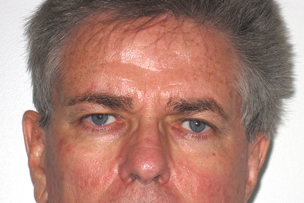before blepharoplasty male patient front view case 3341