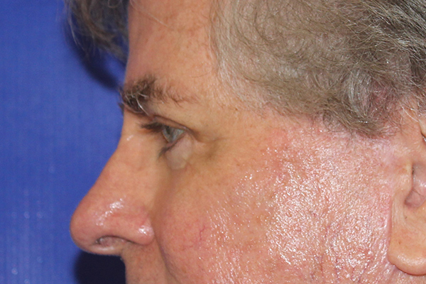 after blepharoplasty male patient side view case 3341
