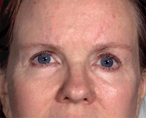 after browlift front view female patient case 3330