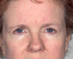 before browlift front view female patient case 3330