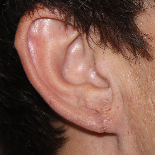after earlobe repair case 3299