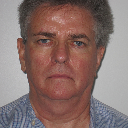 before face and neck lift male patient front view case 3291