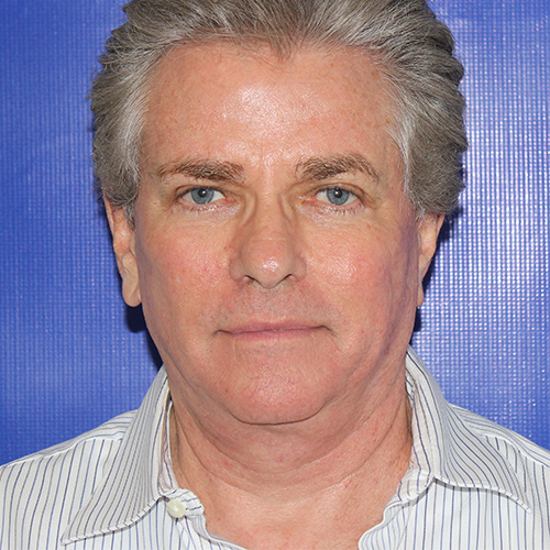 after face and neck lift male patient front view case 3291