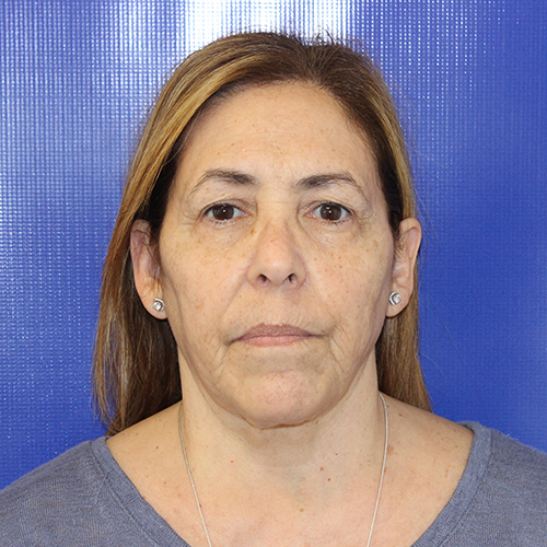 before face and neck lift female patient front view case 3294