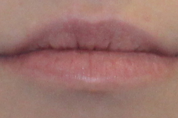 before lip filler female patient 3302