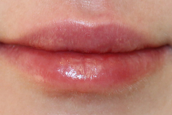 after lip filler female patient case 3302