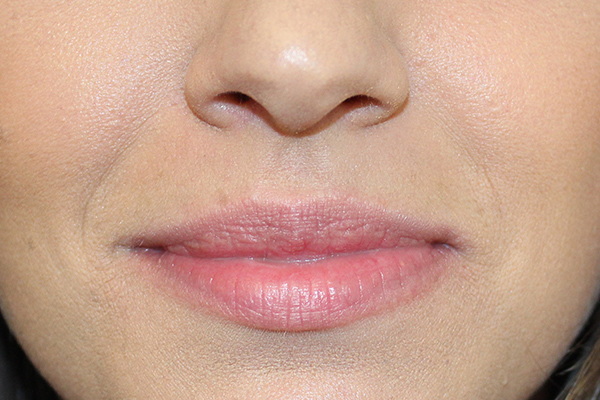 before filler female patient front view case 3305